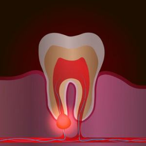 cracked tooth syndrome waterford west