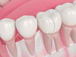 Crown For A Cracked Tooth image