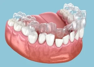 How to Straighten Bottom Teeth: Simple Guide for a Healthier, Straighter Smile 38 model of mouth being corrected using invisalign