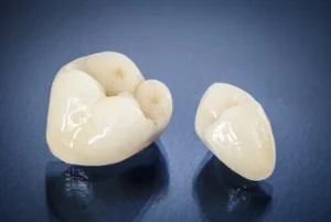 Veneers vs Crowns vs Bonding: What’s the Difference and Which May Suit You? 38 samples of dental crowns